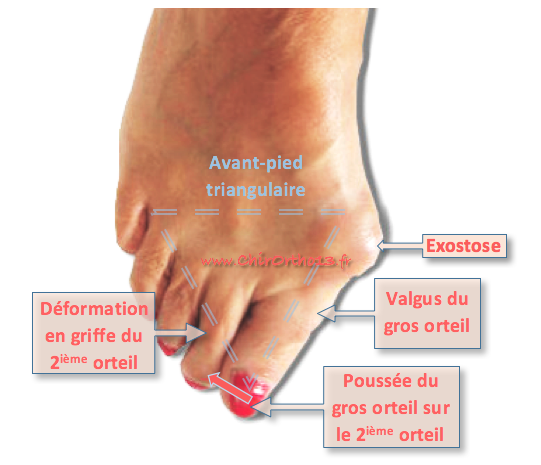 Hallux valgus et autres pathologies de l avant pied mécanismes et