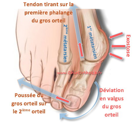 Hallux valgus et autres pathologies de l'avant-pied - ChirOrtho13.fr